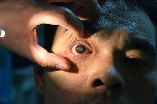 【普瑞十年】角膜穿孔患者，一周内可行角膜移植术