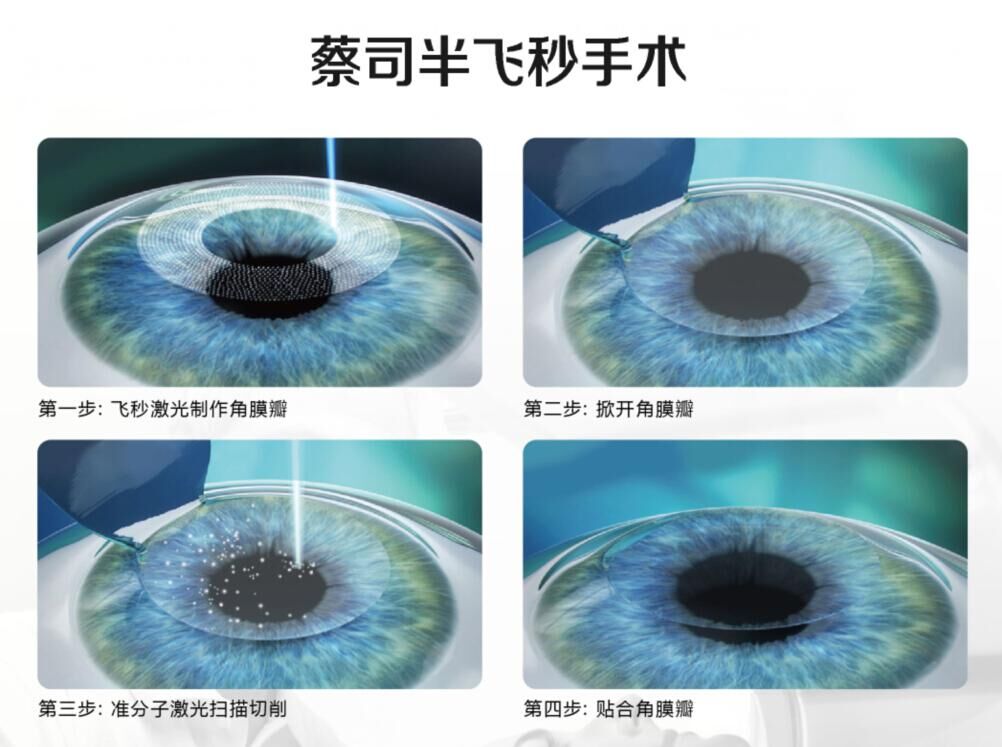 蔡司全飞秒、蔡司半飞秒近视手术与宇航飞秒的