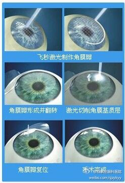 TransPRK与宇航飞秒激光近视手术哪个好? - 散