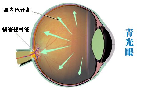 青光眼眼压高是怎么回事?如何