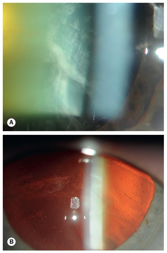 普瑞专家说｜白内障分型之——皮质性白内障